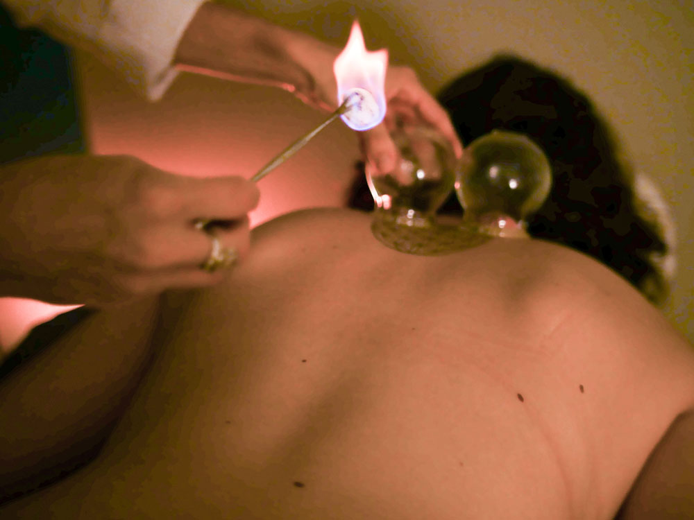 tcm-cupping-wellness-treatment-evenstar-acupuncture